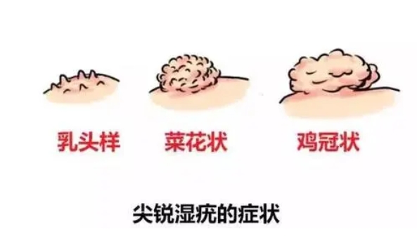 成都尖銳濕疣醫(yī)院