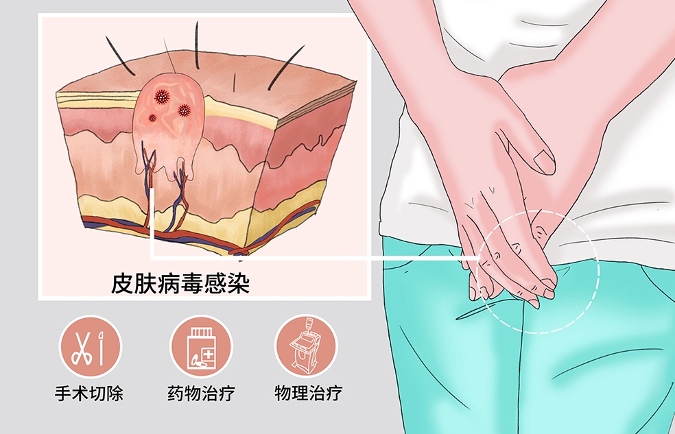 成都尖銳濕疣醫院